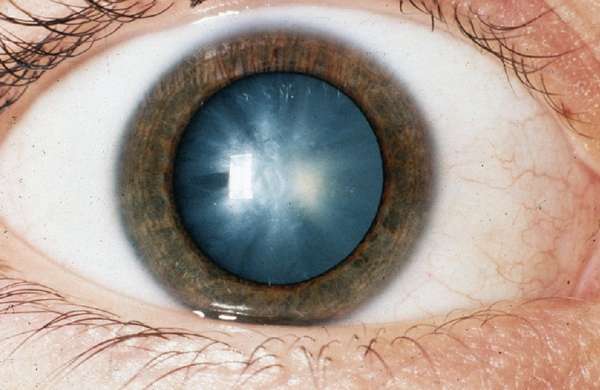 Лечение катаракты народными средствами в домашних условиях